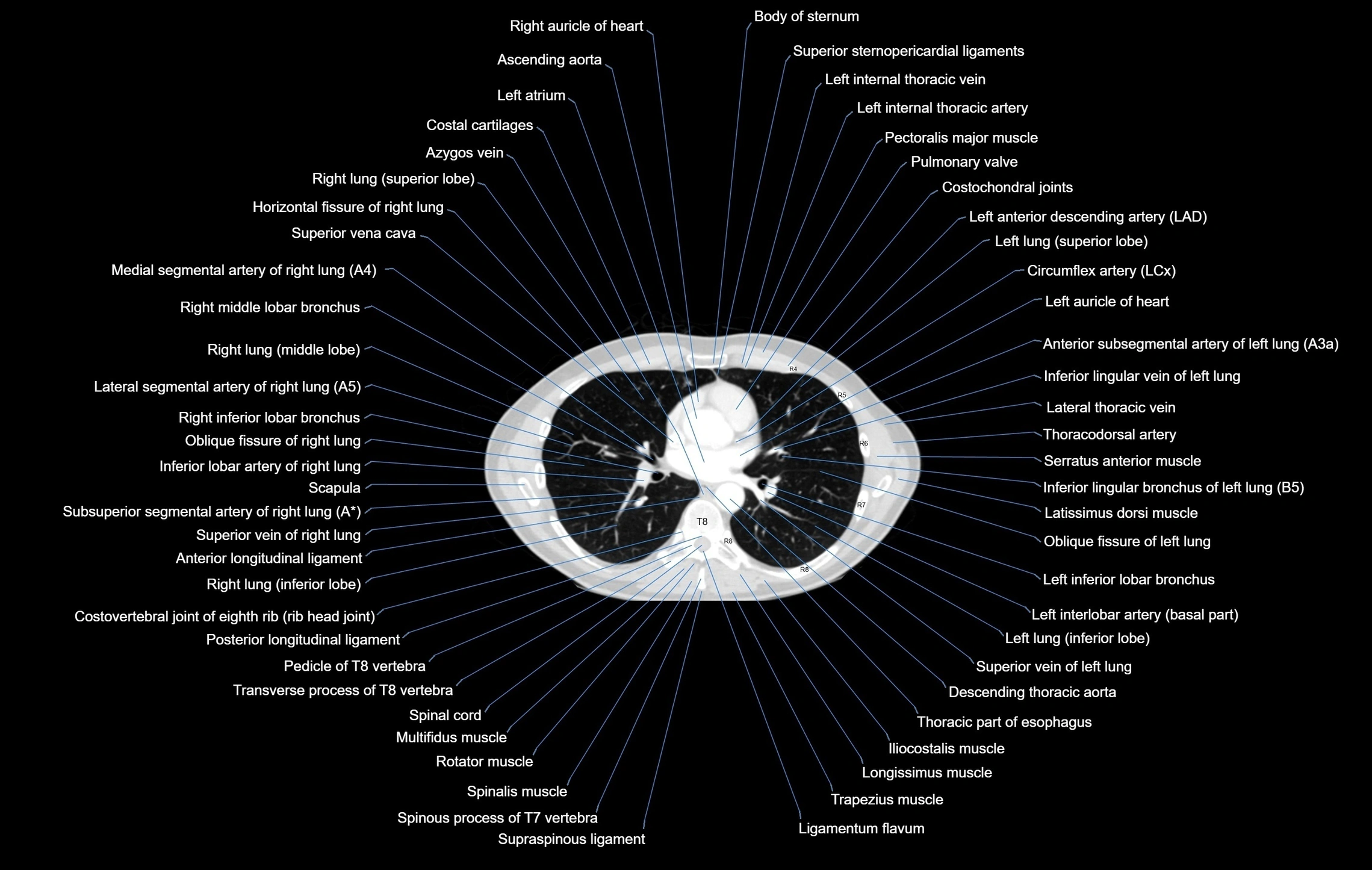CT chest (thorax) labelled axial cross sectional anatomy radiology image-00065.webp